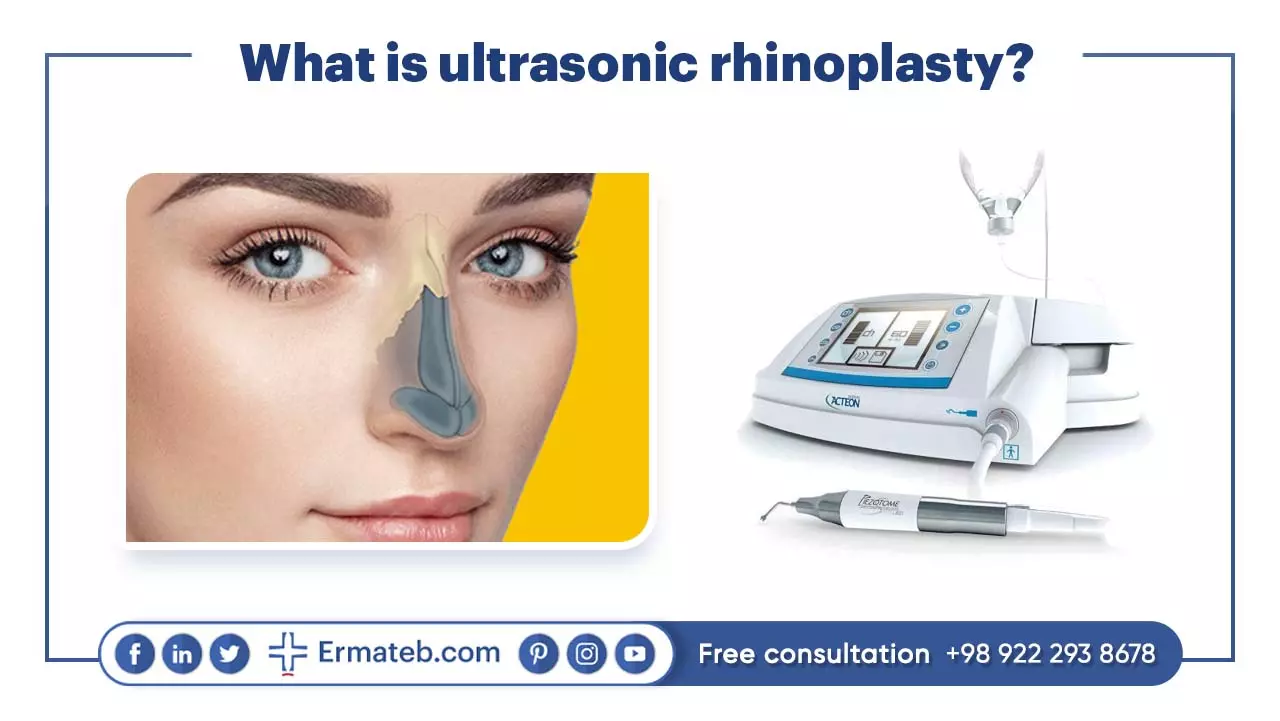 What is ultrasonic rhinoplasty?