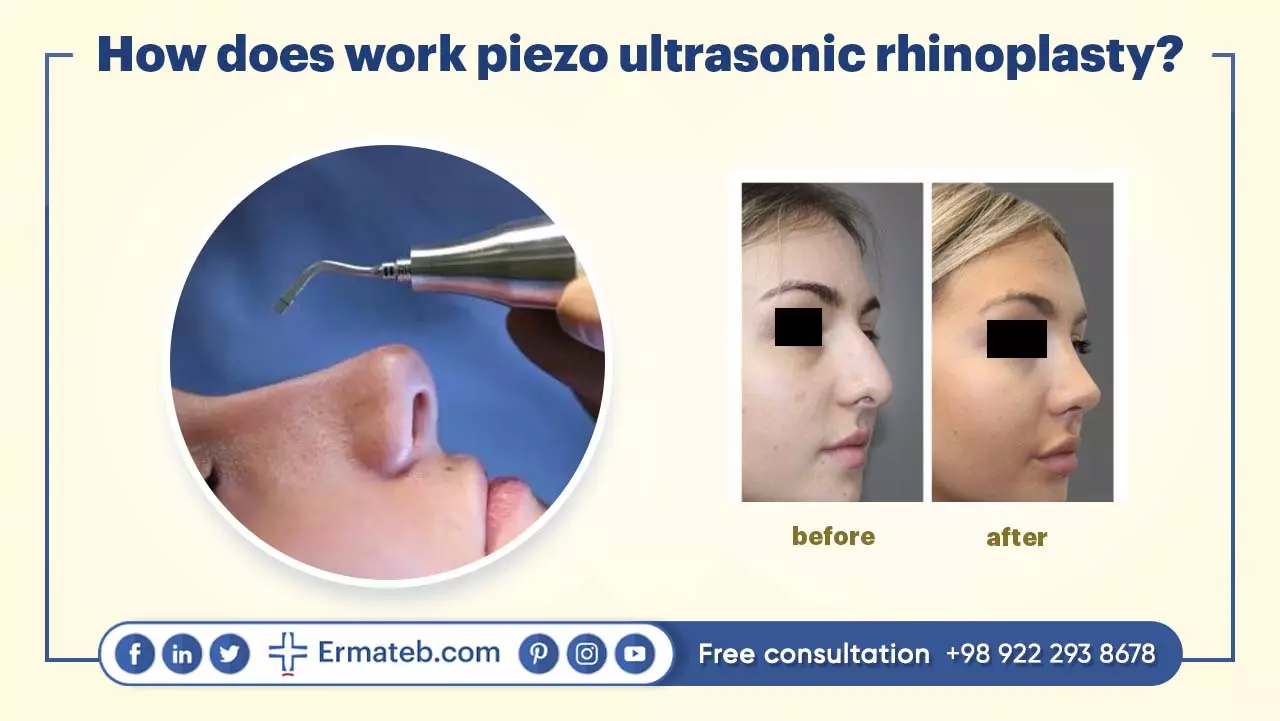 How does work piezo ultrasonic rhinoplasty?