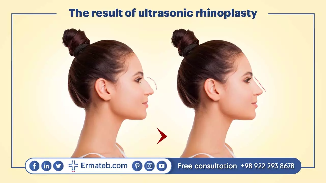 The result of ultrasonic rhinoplasty