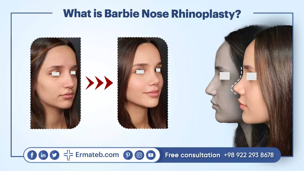 What is Barbie Nose Rhinoplasty?