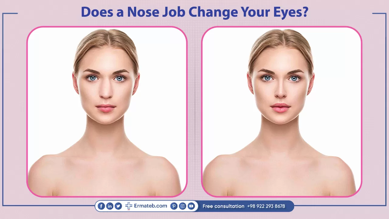 Does a nose job change your eyes?