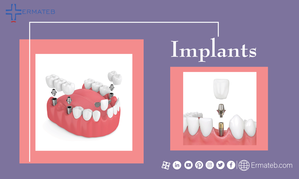 cosmetic dental surgery implants