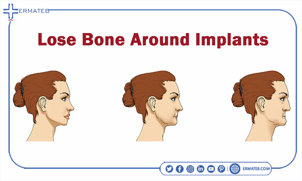 lone bone around implants