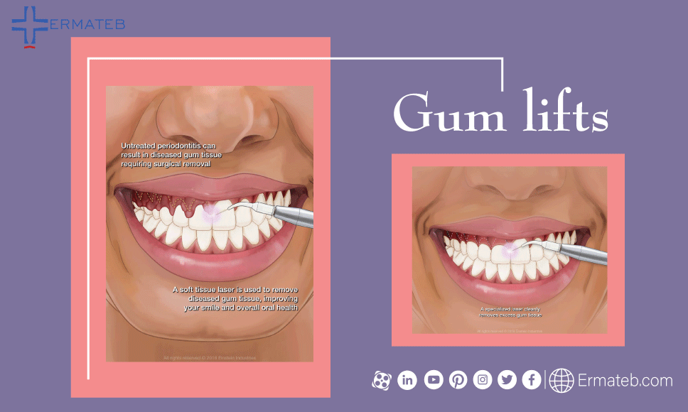 cosmetic dental surgery gum lift