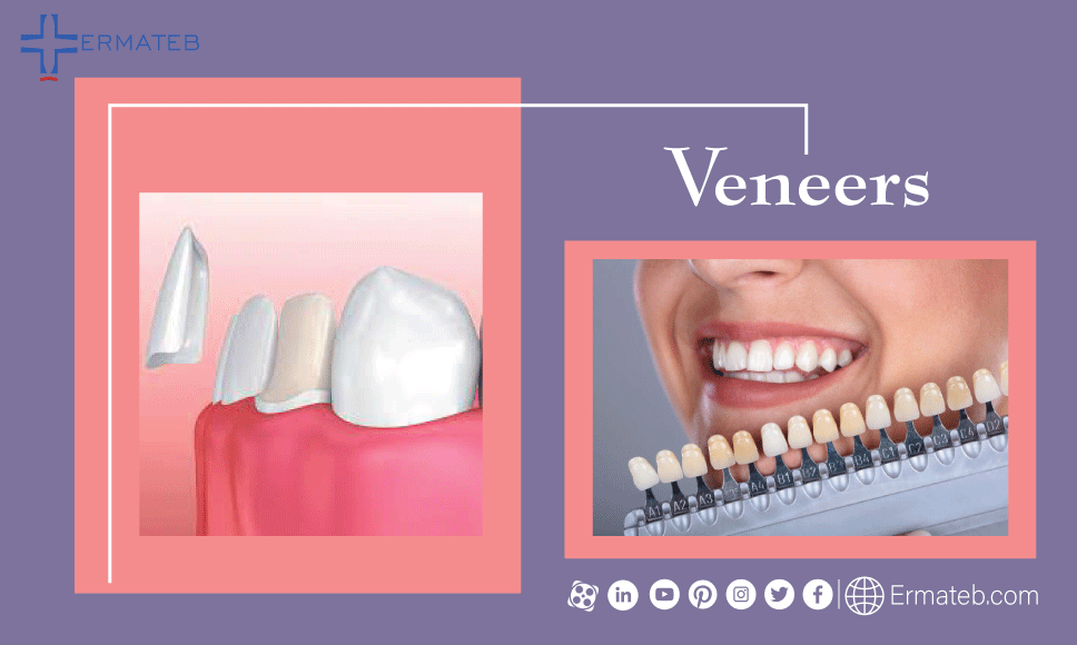 cosmetic dental surgery veneers