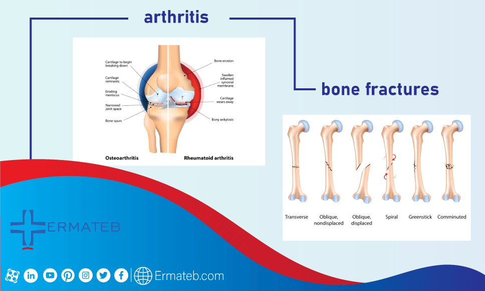 arthritis , bone fractures