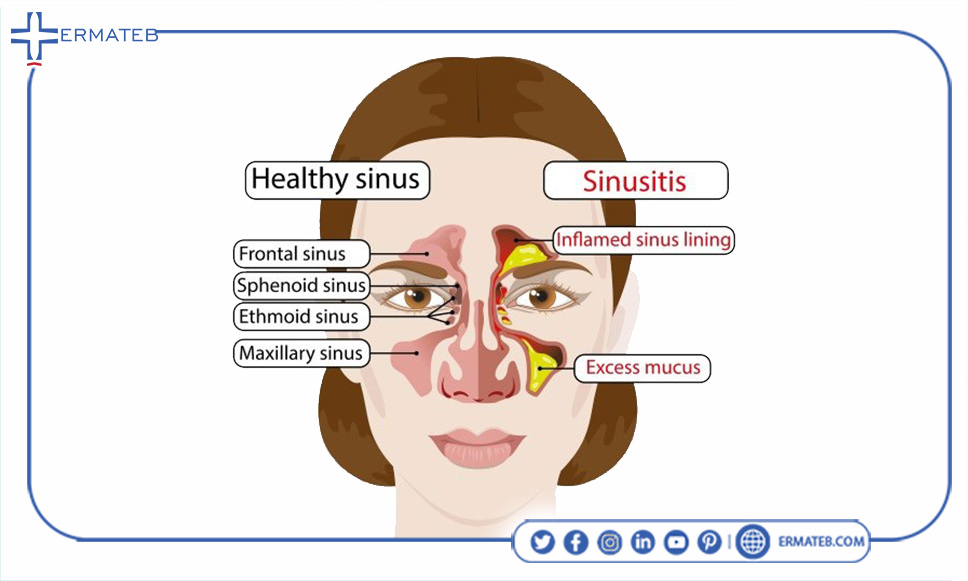 what is sinusitis