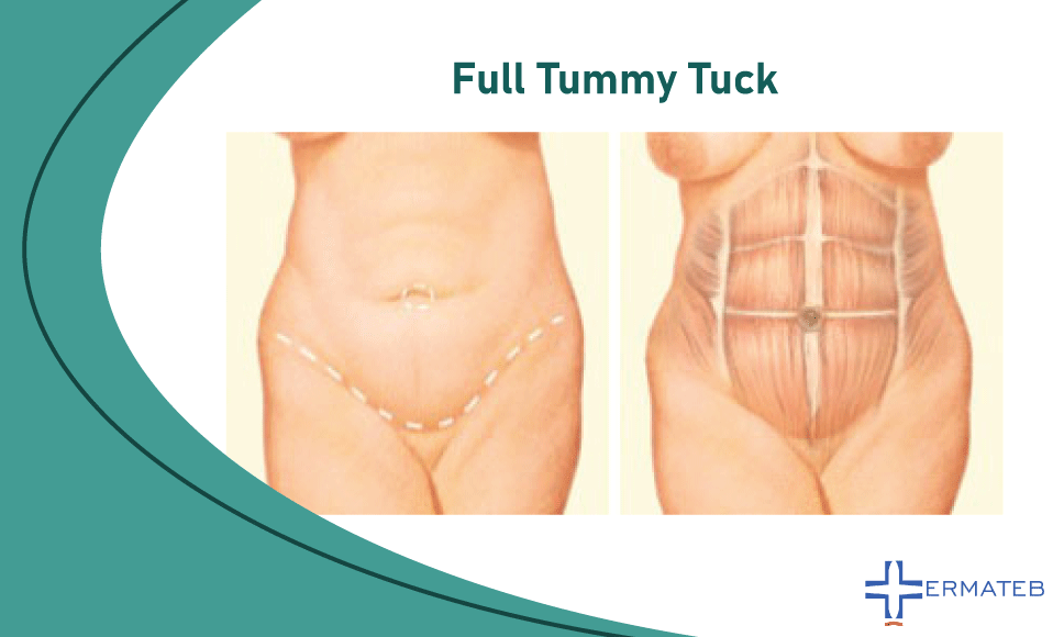 Tummy Tuck In Iran The Procedure Recovery