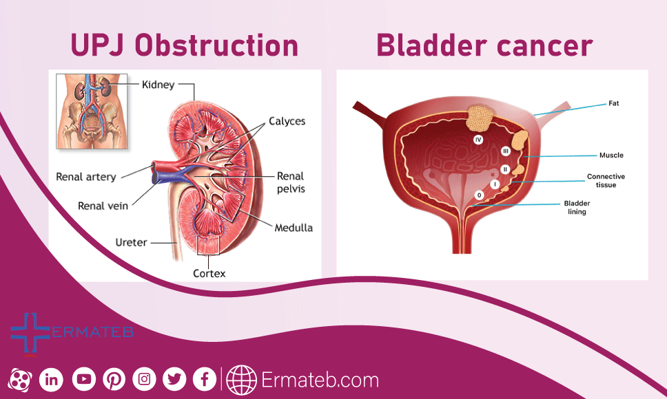 Bladder cancer UPJ Obstruction