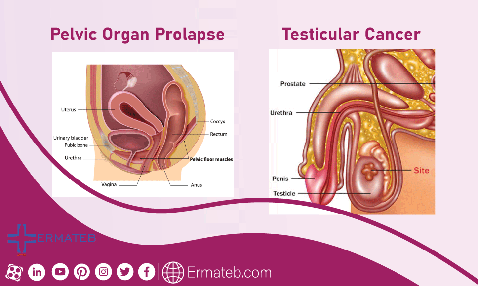 Pelvic Organ Prolapse Testicular Cancer