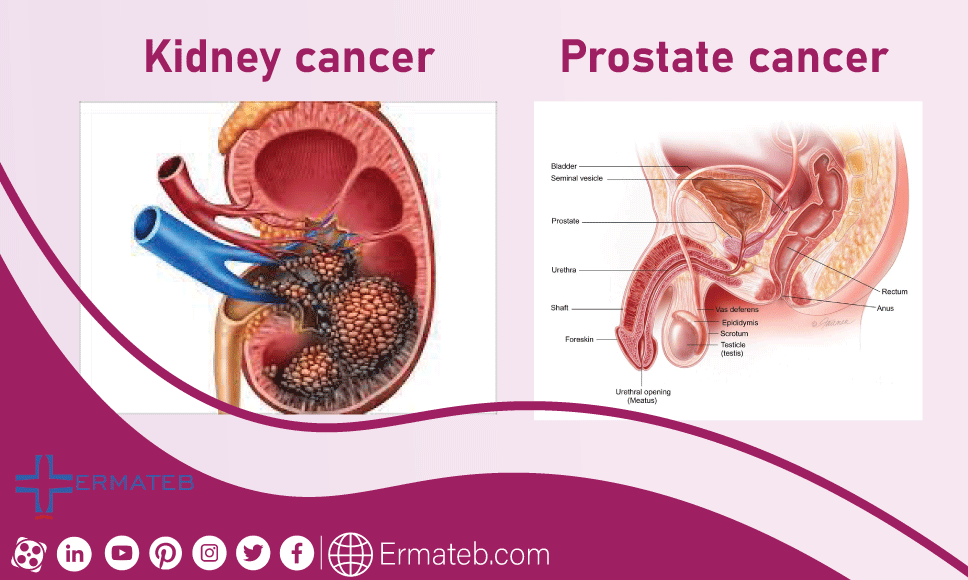 Prostate cancer Kidney cancer