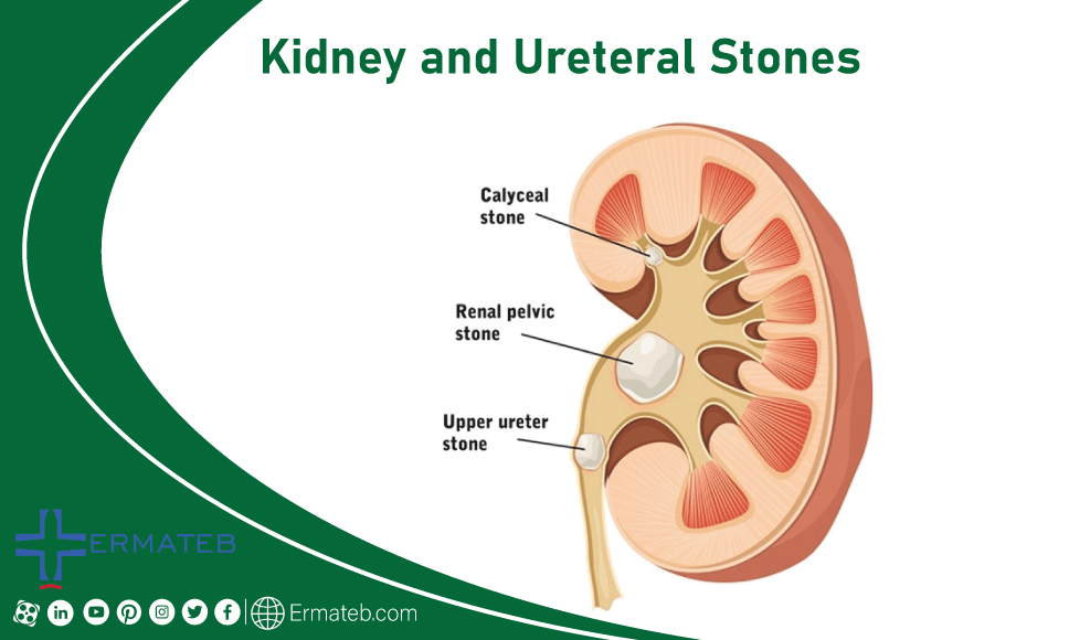 Kidney and Ureteral Stones