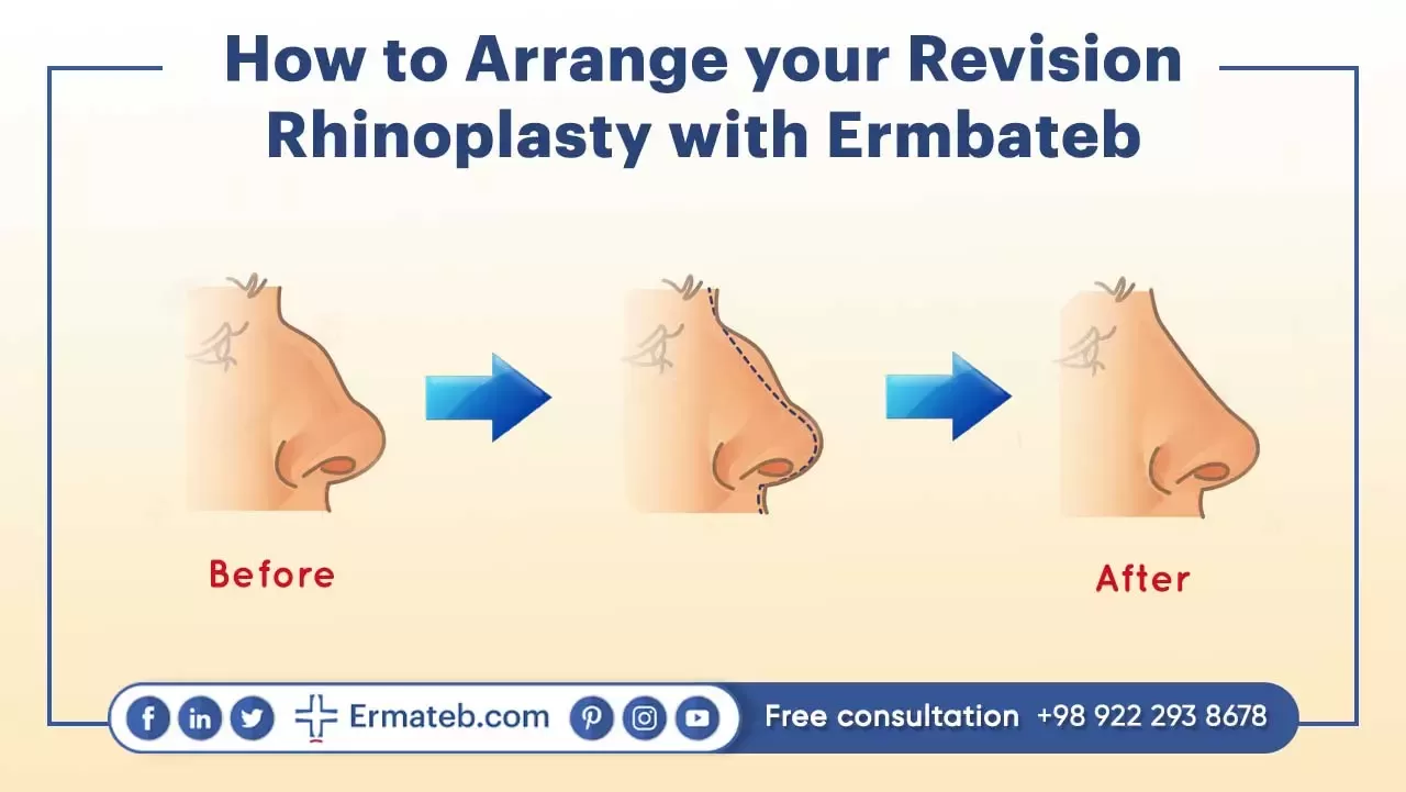 Arrange your Revision Rhinoplasty