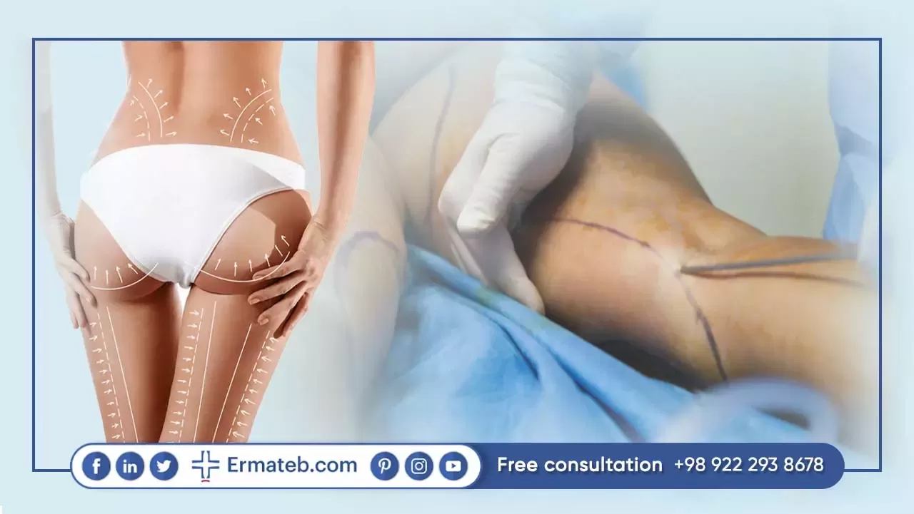 Iranian Liposuction Surgeons