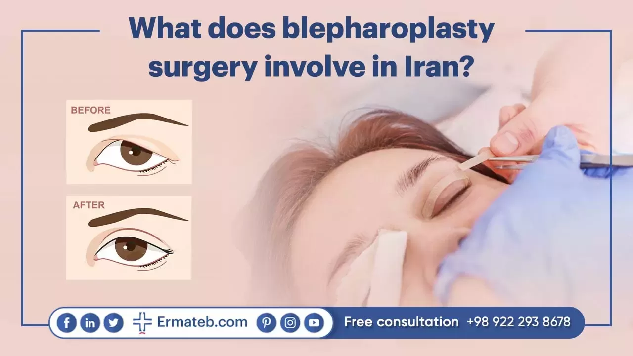 blepharoplasty surgery in Iran
