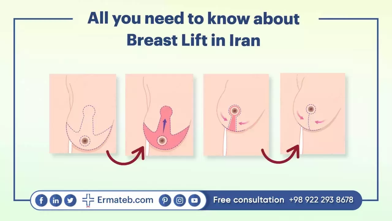 All you need to know about Breast Lift in Iran