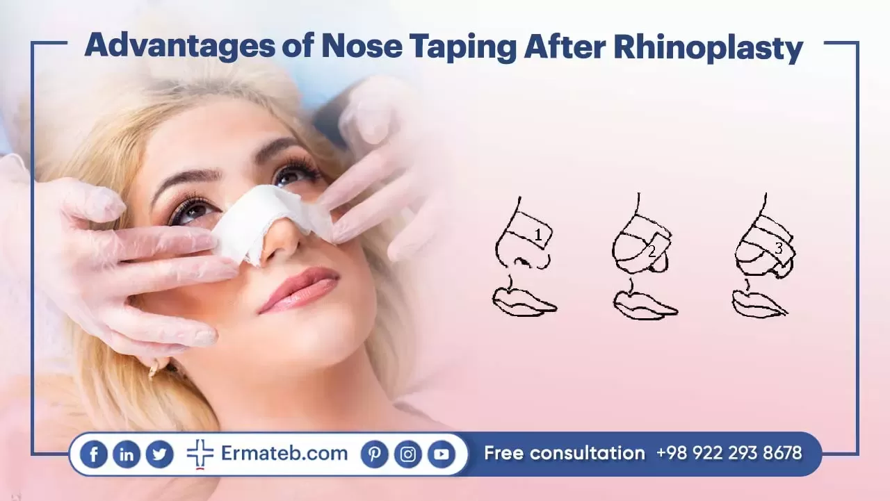 Advantages of Nose Taping After Rhinoplasty