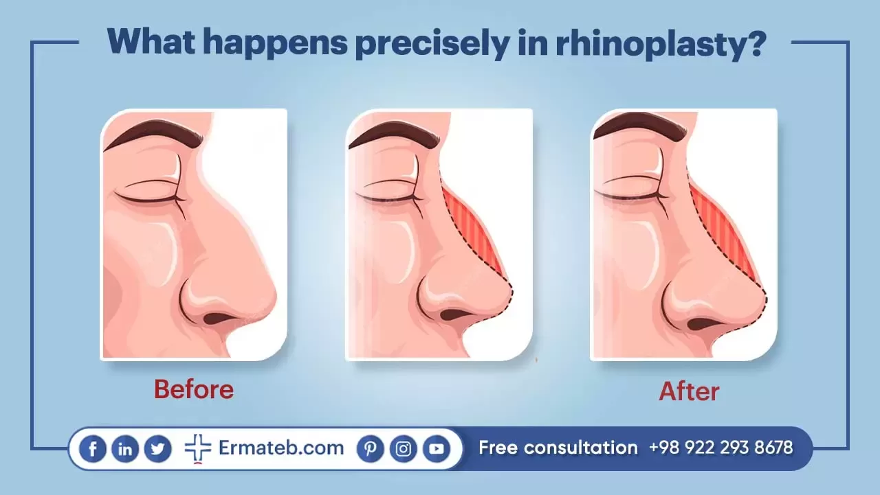 What happens precisely in rhinoplasty?
