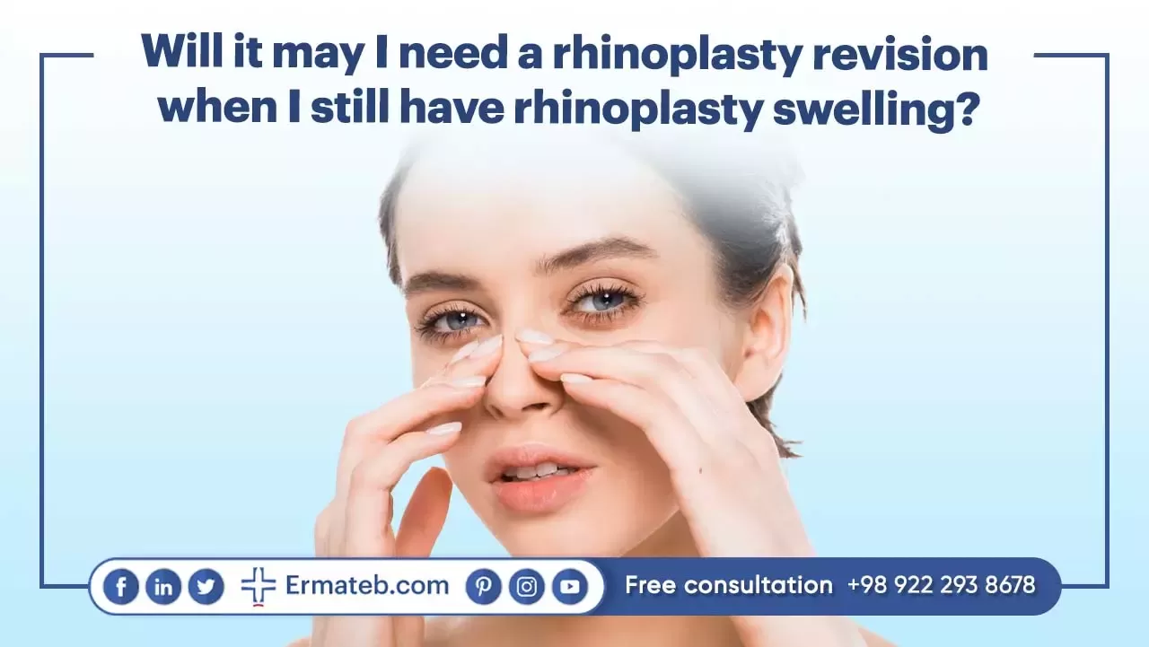 Will it may I need a revision rhinoplasty when I still have rhinoplasty swelling?