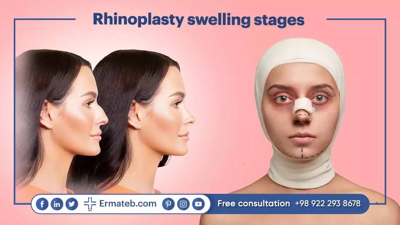 Rhinoplasty swelling stages