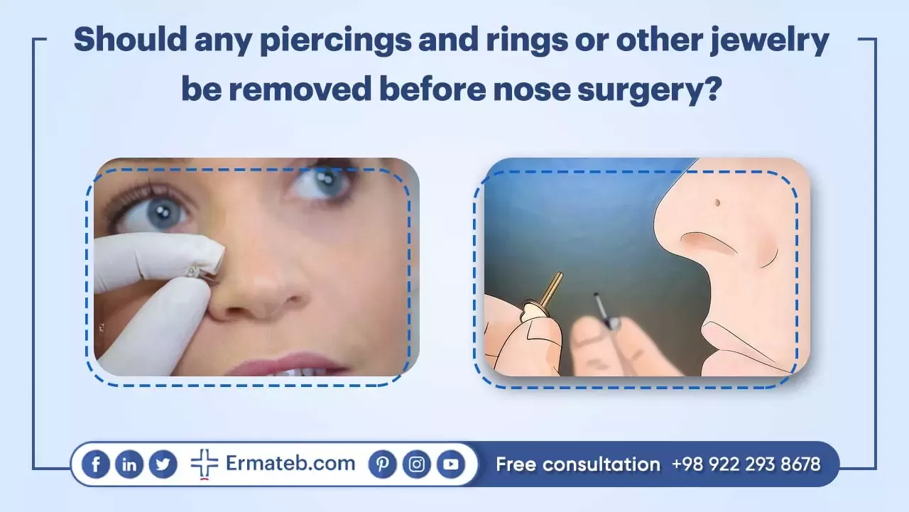 Should any piercings and nose rings or other jewelry be removed before nose surgery?