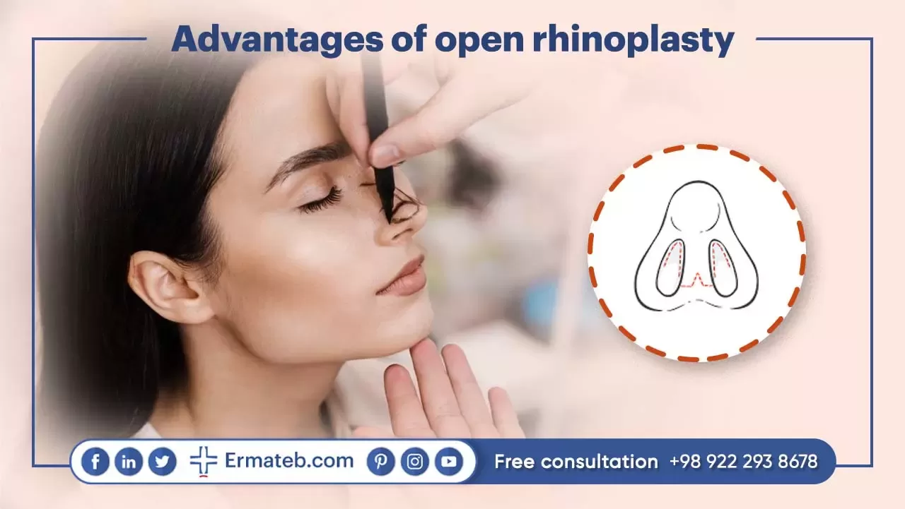 Advantages of open rhinoplasty