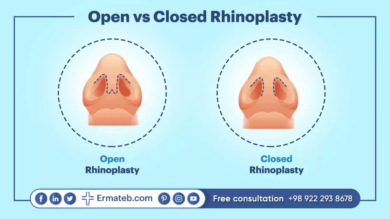 Open vs Closed Rhinoplasty