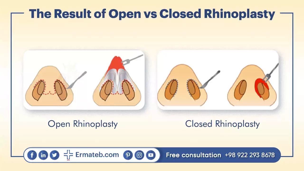 The Result of Open vs Closed Rhinoplasty