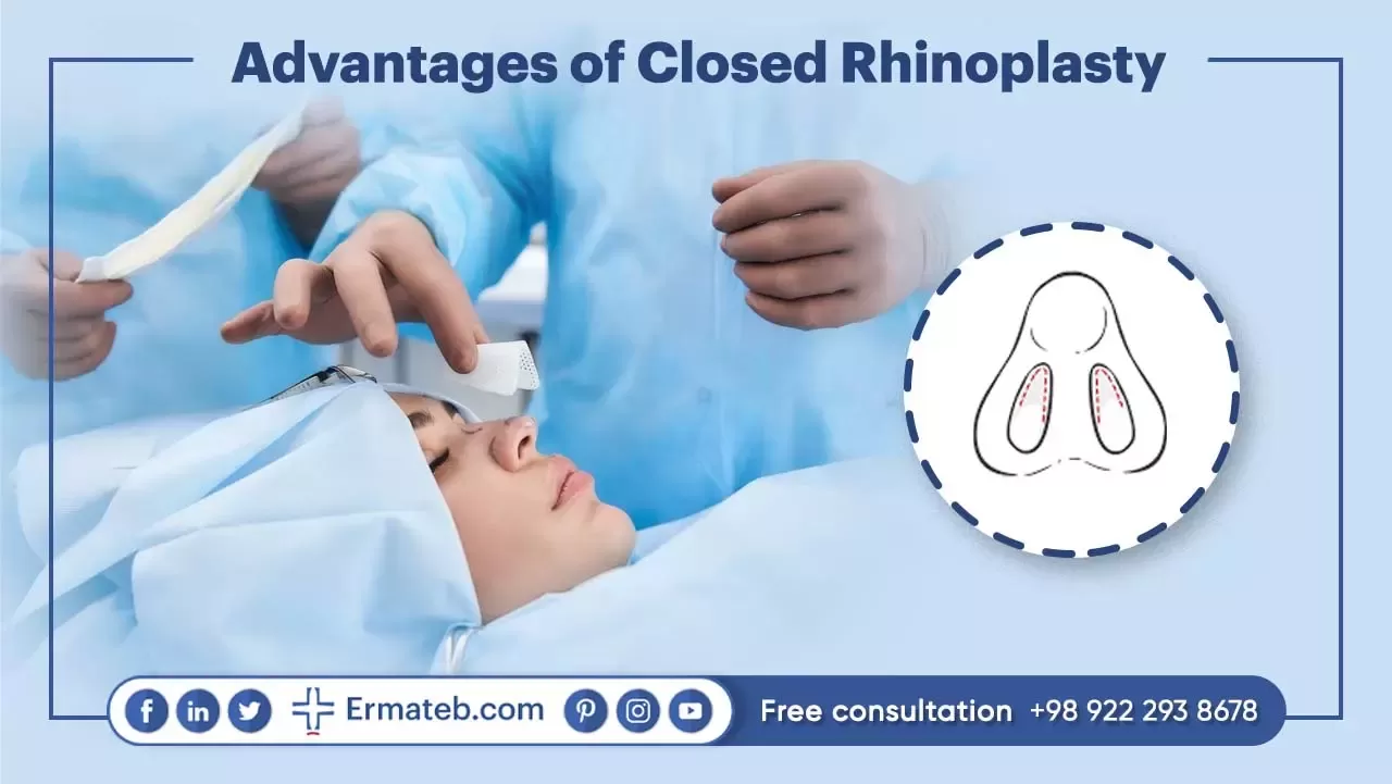 Advantages of Closed Rhinoplasty