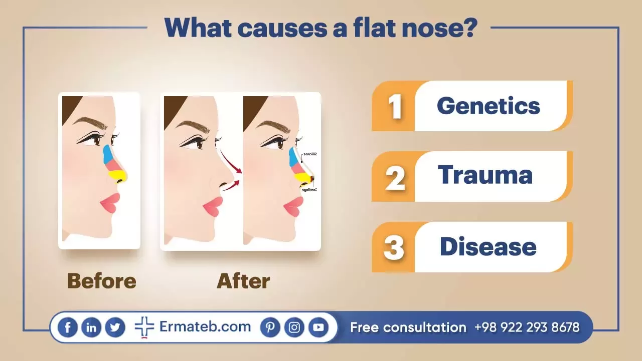 WHAT CAUSES A FLAT NOSE?