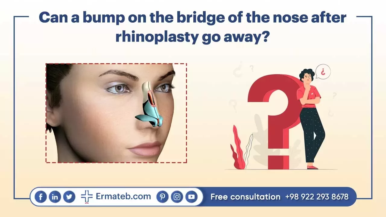 Can a bump on the bridge of the nose after rhinoplasty go away?