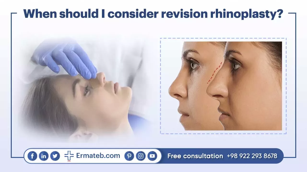 When should I consider revision rhinoplasty?