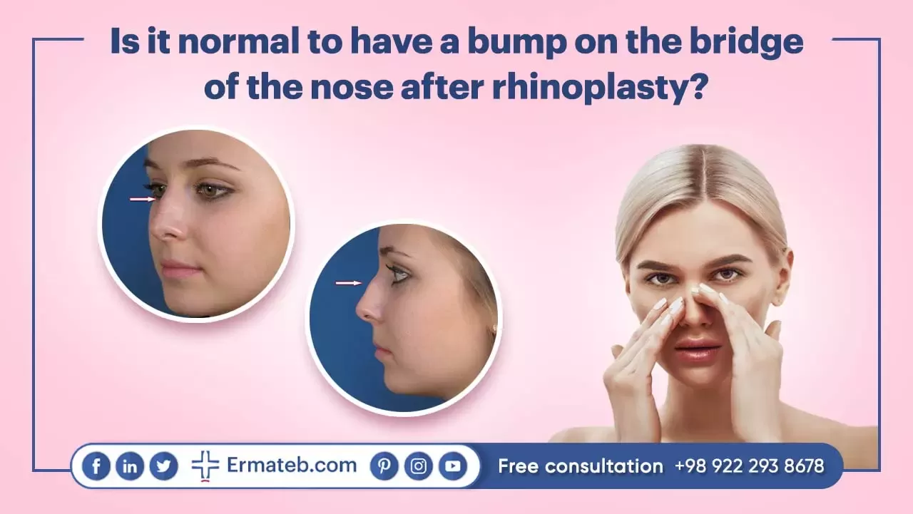  Is it normal to have a bump on the bridge of the nose after rhinoplasty? 