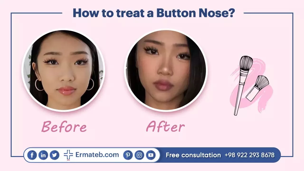 How to treat a Button Nose?