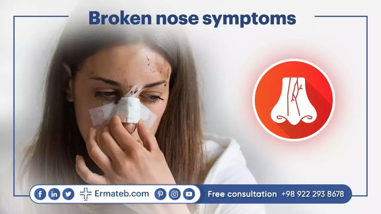 Broken nose symptoms: