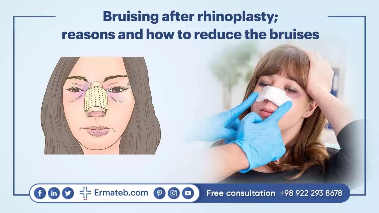 Bruising reasons after rhinoplasty