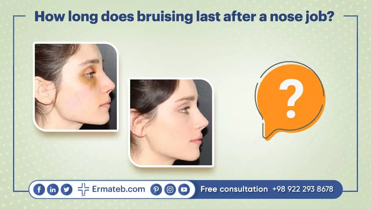How long does bruising last after a nose job?