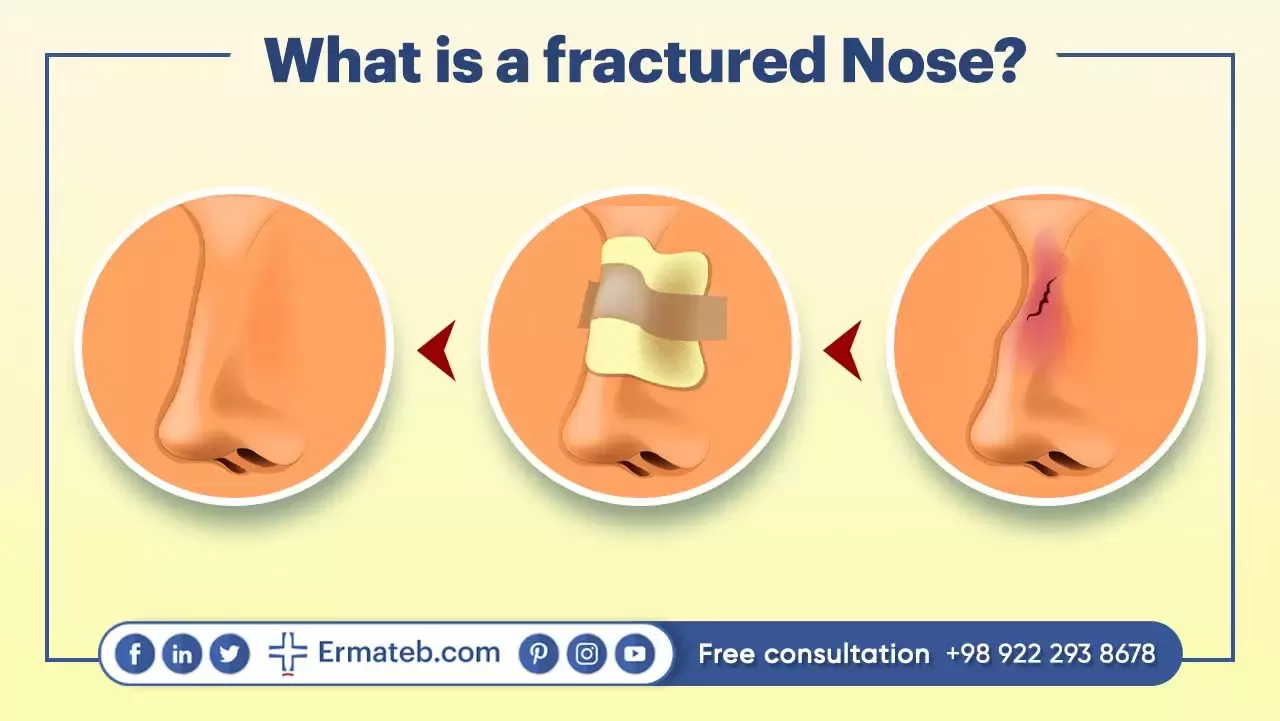 What is a fractured Nose?