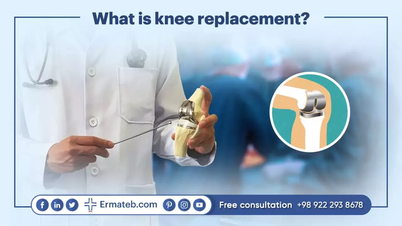 WHAT IS KNEE REPLACEMENT?