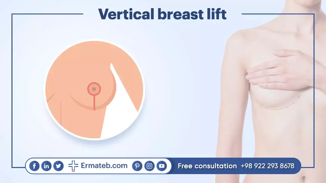 Vertical breast lift: