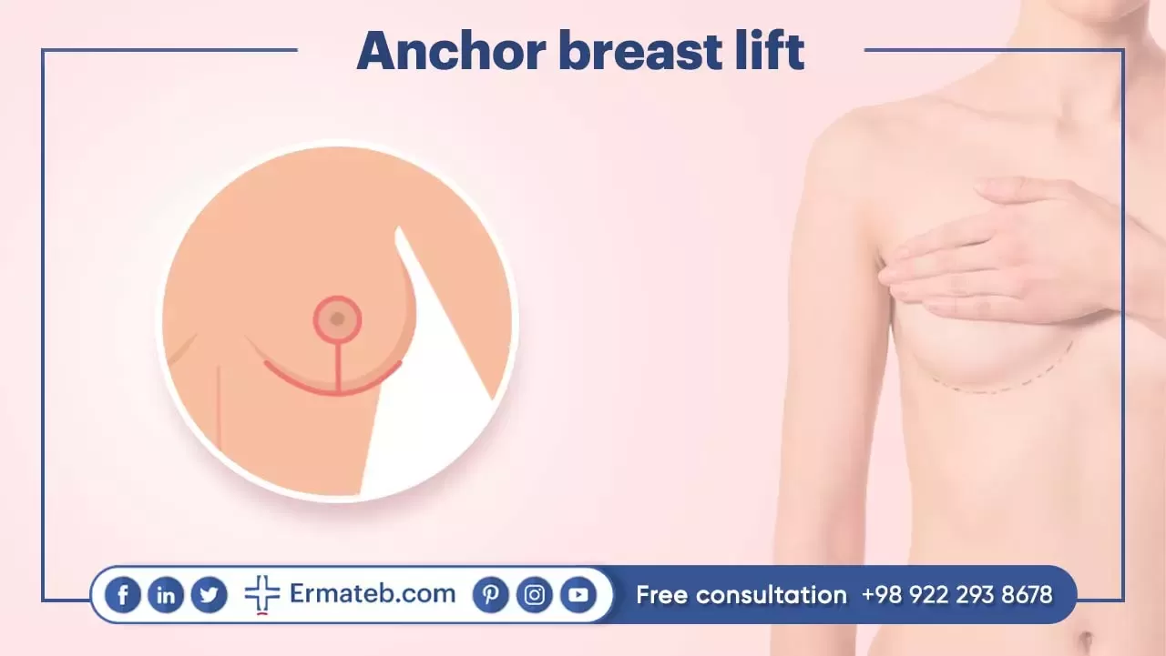 Anchor breast lift: 
