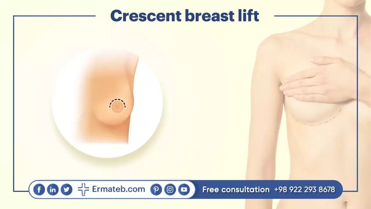 Crescent breast lift: 