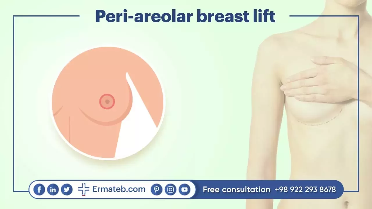Peri-areolar breast lift