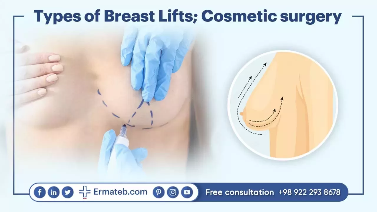 There Are 4 Types Of Breast Lift