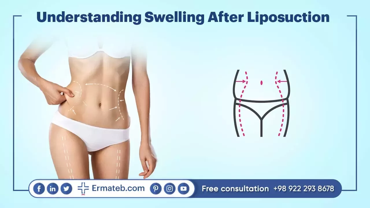 Understanding Swelling After Liposuction