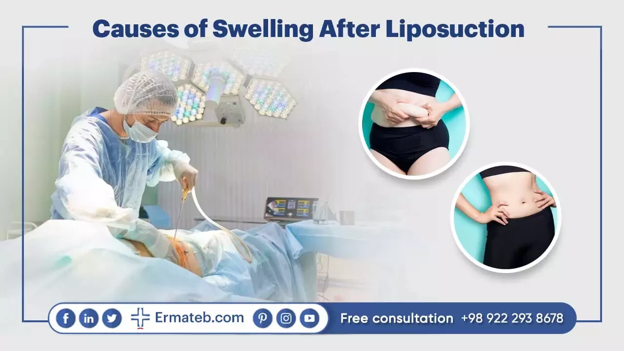 Causes of Swelling After Liposuction