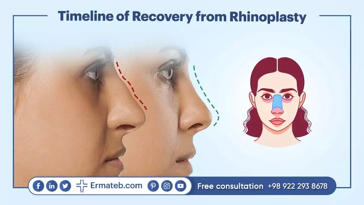 Timeline of Recovery from Rhinoplasty