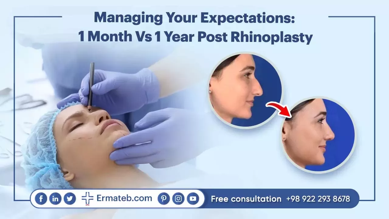 Managing Your Expectations: 1 Month Vs 1 Year Post Rhinoplasty