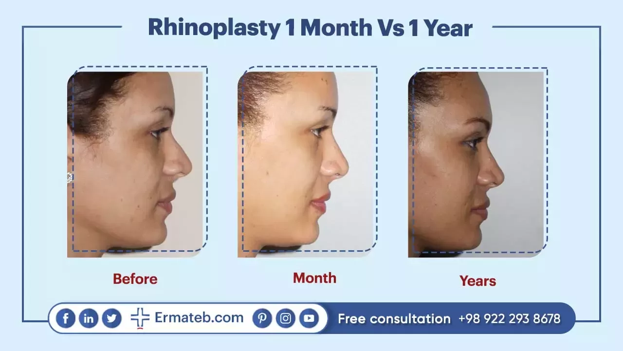 Rhinoplasty 1 Month Vs 1 Year