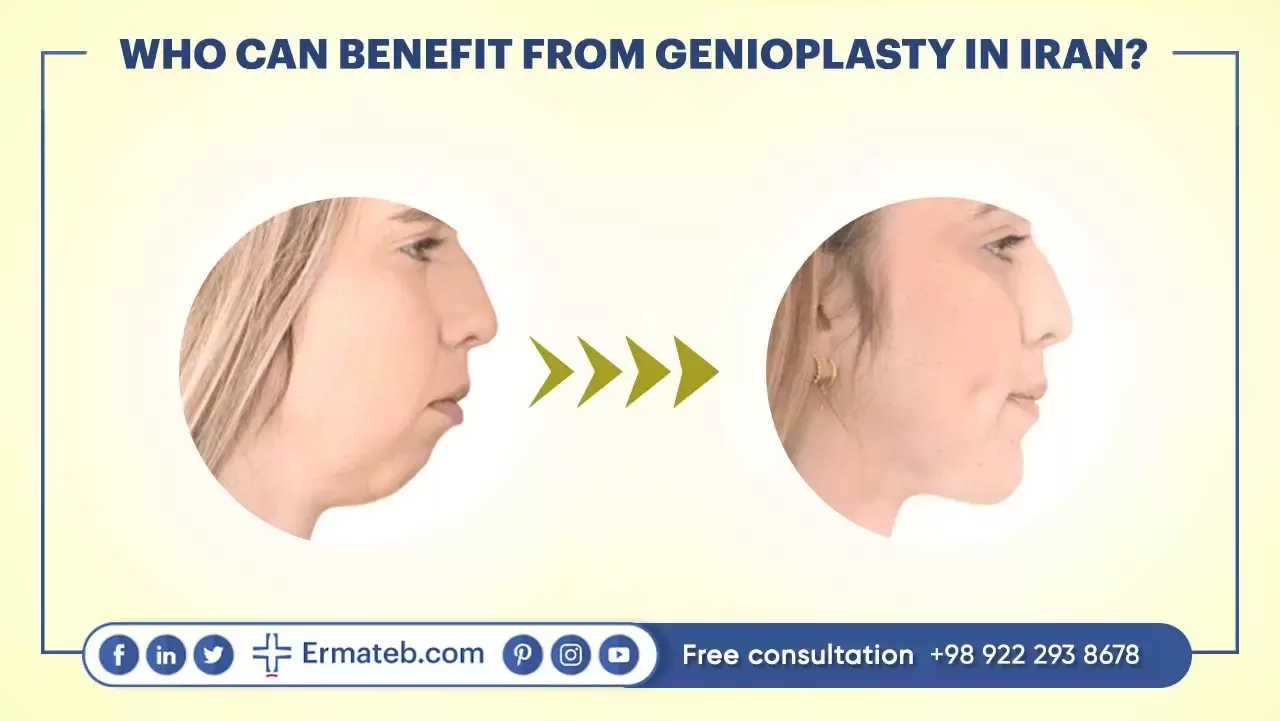 Who can Benefit from Genioplasty 